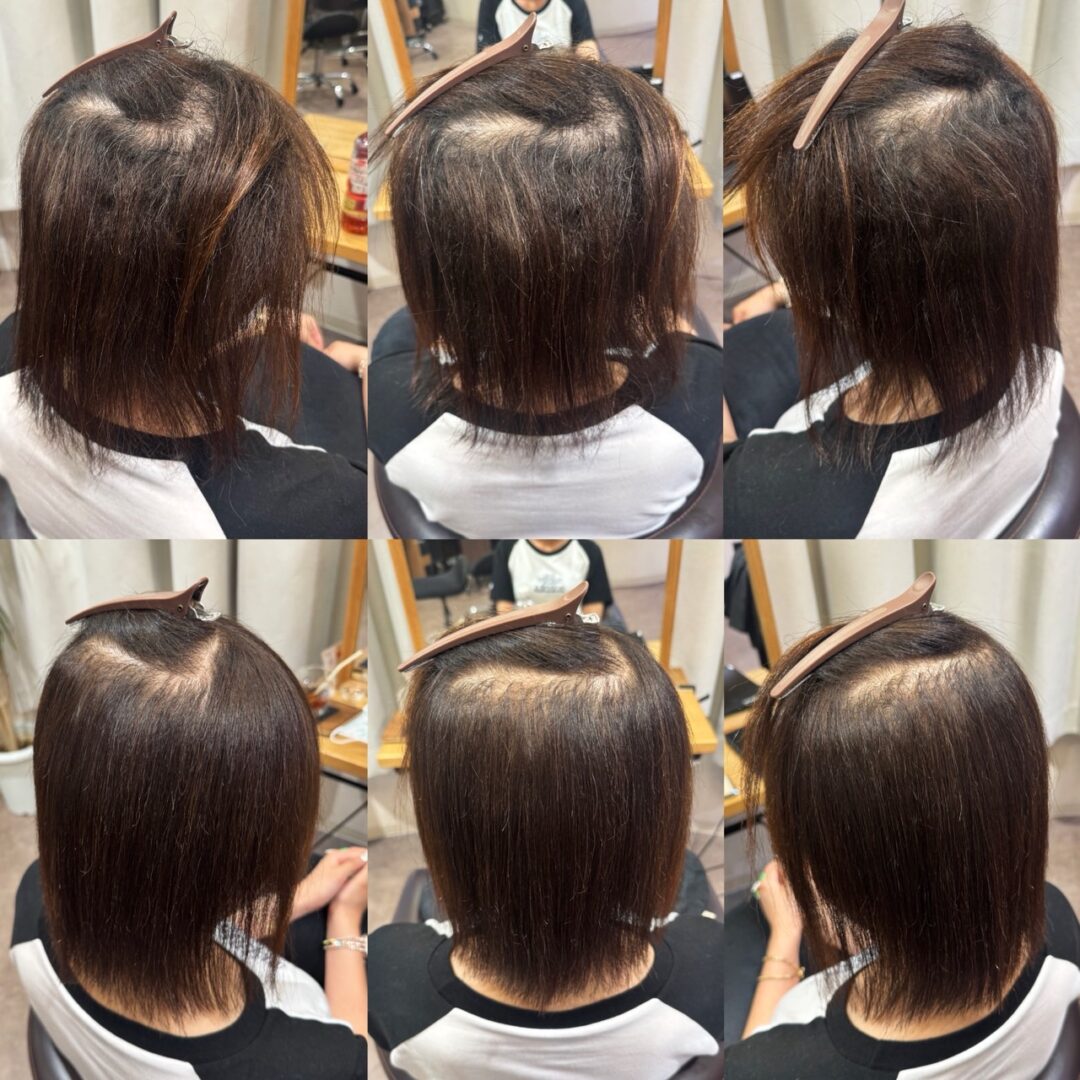 先天性乏毛症（せんてんせいぼうもうしょう）・縮毛症に縮毛矯正は可能？